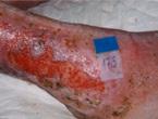 Has an offensive odour indicating infection or colonisation of bacteria. Palliative. Wound extends to tissues deep into the epidermis and dermis.