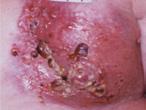 Consider use of Antimicrobials. To manage odour, bleeding and exudate. To promote granulation from the base of the wound.