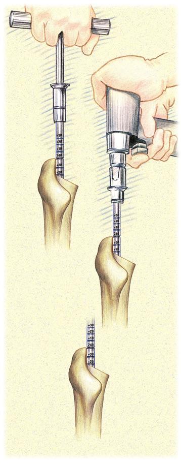 Distal Reaming Fluted & Plasma Straight Stems Use of the Cylindrical Distal Reamer - 127mm & 167mm Straight Stems Cylindrical distal reaming for the 127mm or 167mm Fluted & Plasma Straight Distal