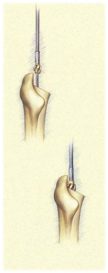 Distal Reaming Fluted & Plasma Straight Stems (continued) Use of the Cylindrical Distal Reamer - 127mm & 167mm Straight Stems (continued) Progressively ream until resistance accompanied by cortical