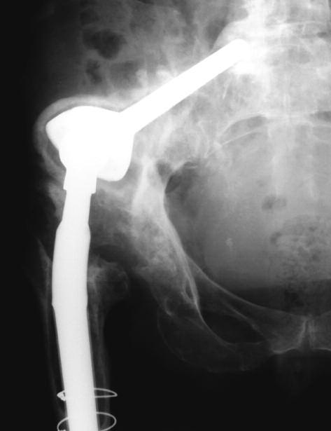 2 Follow-up AP radiograph of a hip revised with a cementless Wagner stem and a McMinn stemmed cup, which is loose and has undergone marked proximal migration. (fig 1).