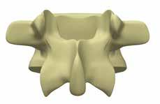 4.2 The MySpine device profile To address the maximum stability and improve screw entry points targeting, the MySpine placement guides profiles are specifically designed for treatment of the