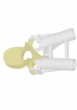 Standard Guides Low Profile Guides In the treatment of the thoracic spine segments the MySpine guides are developed to maximize contact at the spinous process and both lamina and transverse