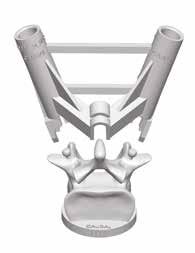 A plastic 3D anatomic model reproducing the patient s vertebra is provided to simulate the correct positioning of the MySpine guides in the OR. 19. Low Profile Guides 17.