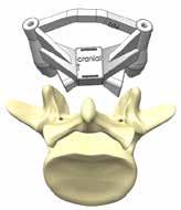 between the vertebra s plastic model and the MySpine guides in order to become familiar with the overall system and simulate the position of the guides on the contact surfaces and entry points.
