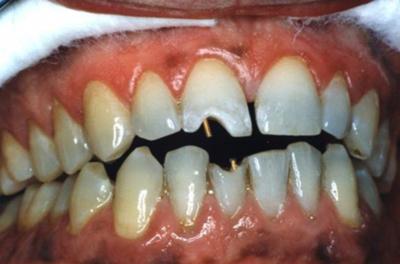cases, arises from the loss in the clinical crown height which, in turn, may affect the occlusal vertical dimension.