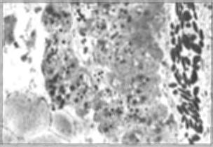 TEM section of aflatoxin-treated pancreatic acini with dilated rough endoplasmic reticulum, condesed nucleus and another type of granules with osmiophilic core (Mag. X10,800 ).
