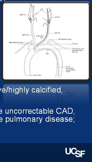 Options for Carotid Disease Carotid Revascularization Wayne Causey, MD 2 nd Year Vascular Surgery Fellow Best medical therapy, Carotid Endarterectomy, and Carotid Stenting Who benefits from best