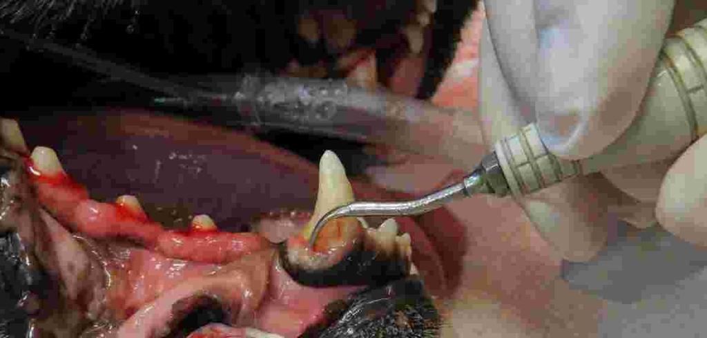 Subgingival Scaling Removal of the plaque and calculus subgingivally (under the gum tissue) is accomplished with a combination of the ultrasonic scaler