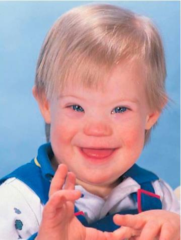AVSD Incidence: 4 % of all CHD Associated with Down Syndrome (50%) Divided into: Complete AVSD
