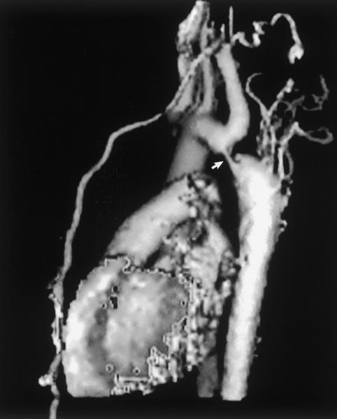 DIAGNOSIS: CoA Chest X-ray: Cardiomegaly Prominent aortic knob Rib