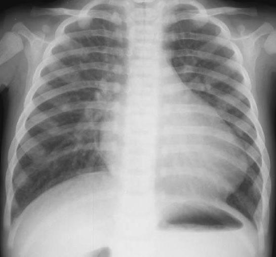 INVESTIGATION: D-TGA Chest X-ray: egg on a string appearance ECG: Typically normal