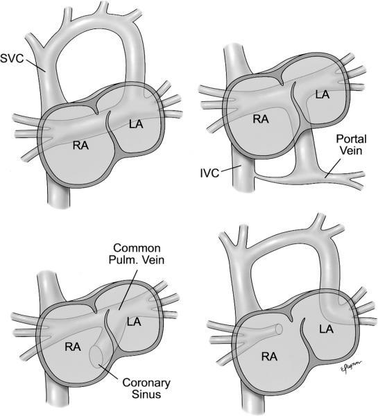 TAPVD All 4 pulmonary veins returns to the right atrium Can be: Supracardiac (50%)