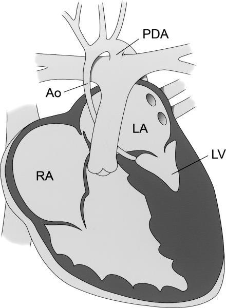 PATHOPHYSIOLOGY: HLHS No adequate flow across aortic valve to ascending aorta Relies on