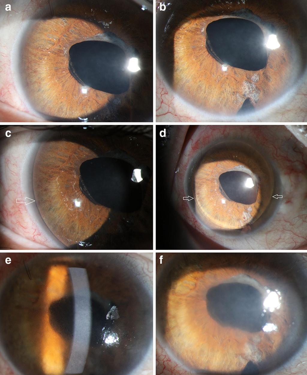914 Int Ophthalmol (2014) 34:913 917 diabetic retinopathy in the right eye.