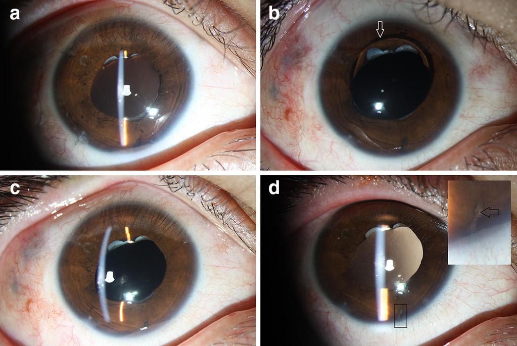 Int Ophthalmol (2014) 34:913 917 915 Fig. 2 Case 3. a A closed PI and an SO-free AC 2 months after surgery. b Forward displacement of the SO to the AC a few hours after laser retinopexy.