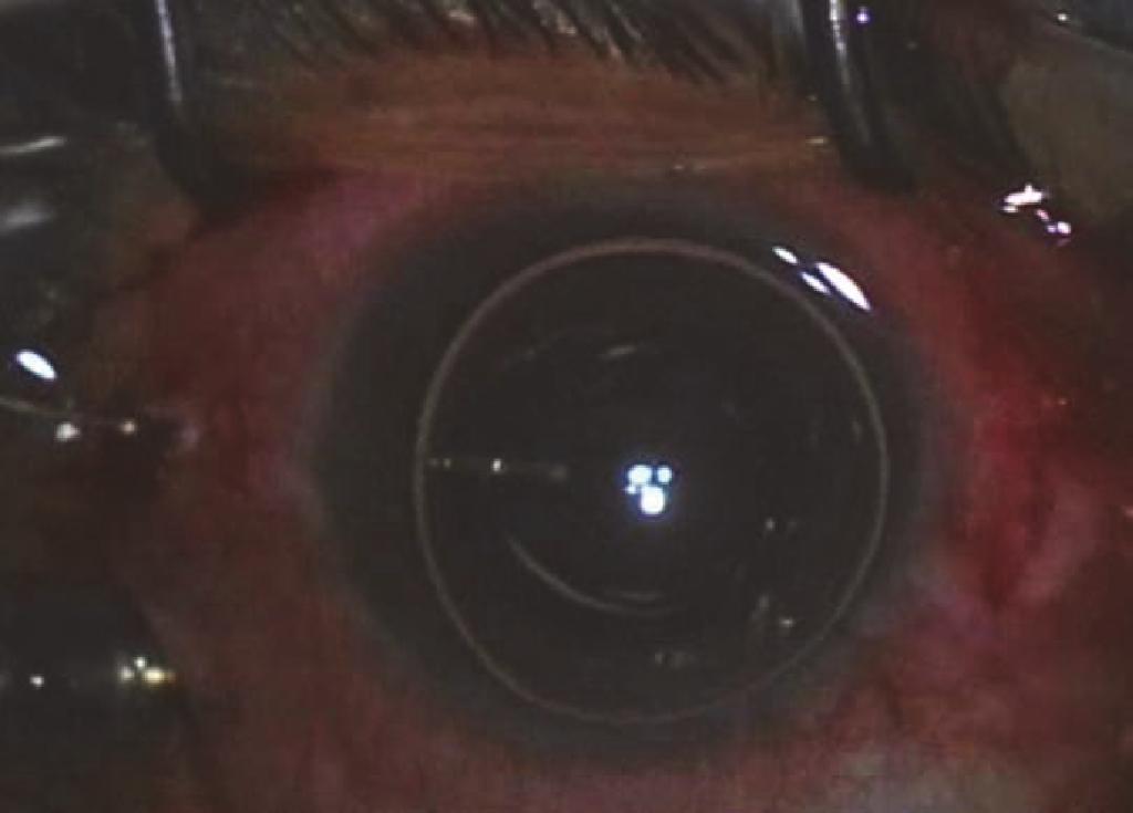 2 Ophthalmology by injecting a small air bubble that fills one-half to two-thirds of the anterior chamber [6].
