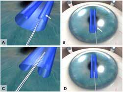 1,4,6 First surgical steps and graft preparation Once the main incision and side ports have been created, the anterior chamber is filled with air to provide better visualization of Descemet membrane