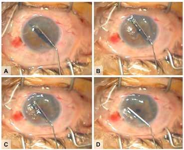 the graft. 11 With the Dapena maneuver, a small air bubble is used as an intraocular tool to unroll the graft inside the anterior chamber (Figure 5).
