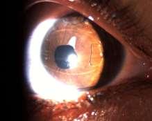 CENTRATION In 2 of 25 eyes (8%), traumatic lens
