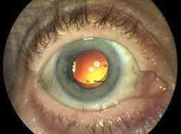 Managing cataracts in children remains a