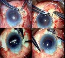 . Sutured Scleral fixation IOL CONCERNS HAVE BEEN RAISED ABOUT THE RISK OF CONJUNCTIVAL AND SCLERAL EROSION OF