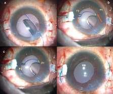 Sutureless Scleral fixation IOL Sutureless intra-scleral haptic fixation of a three-piece