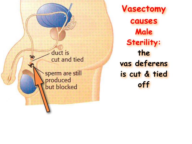 Vasectomy male sterility vas deferens