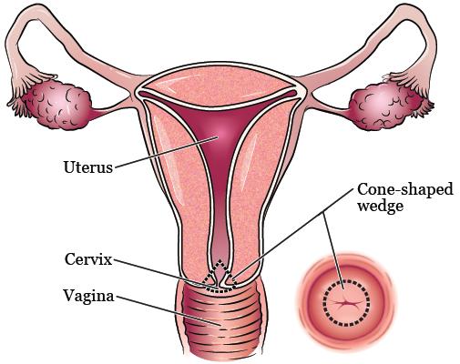 Cervix - opening to uterus Sperm passes through opening.