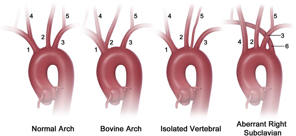 FIGURE 1. Aortic arch branching patterns: normal branching variant of the aortic arch, bovine aortic arch variant, isolated left vertebral artery variant, and aberrant right subclavian artery.