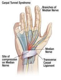 GENERAL INFORMATION Carpal tunnel syndrome (CTS) is the most commonly known repetitive strain injury (RSI). It is just one diagnosis under the umbrella heading of repetitive strain injuries.