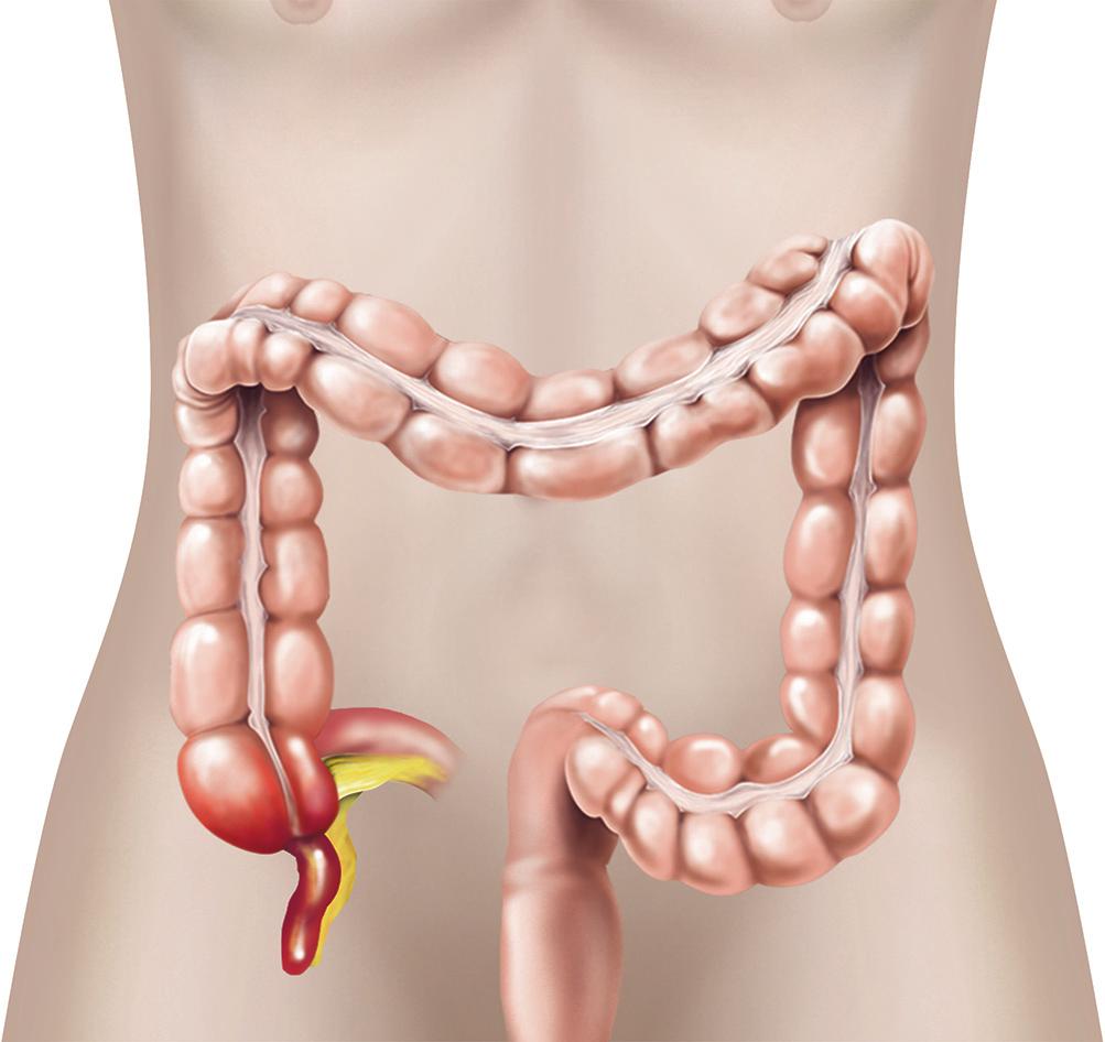 What is appendicitis? Appendicitis means inflammation of your appendix. Your appendix is a part of your large intestine. It has no function in human beings.