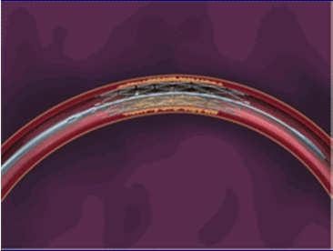 WINGSPAN STENT SYSTEM Important SAMMPRIS Information to Follow 1.