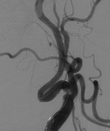 Stenting Indications High Risk Surgical Patients