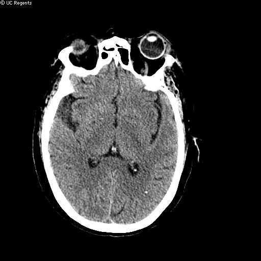 Tandem Stenosis with Intracranial Lesion