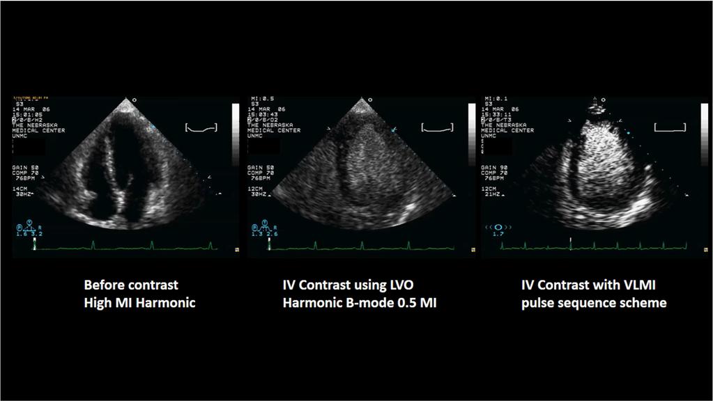 VLMI imaging improves apical and basal segments