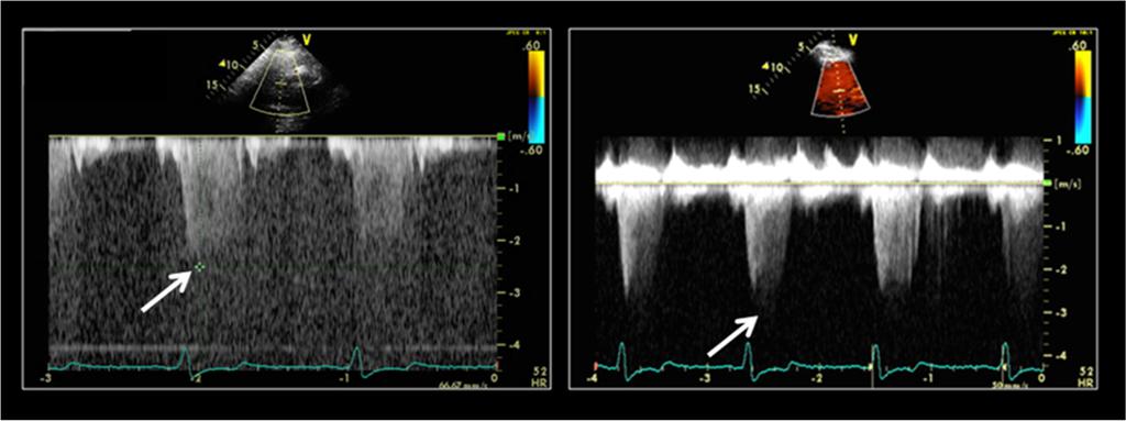 Contrast enhancement of Doppler signals When UEAs being used for imaging.