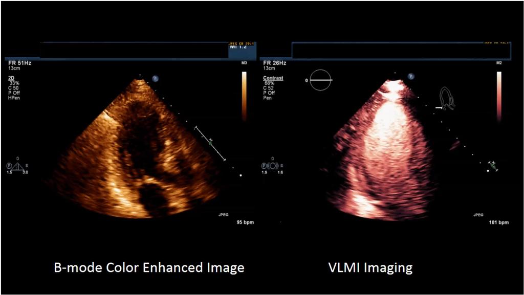 Choice of Imaging modality for LVO: B mode low MI harmonic or Very Low MI (VLMI) VLMI (very low MI < 0.