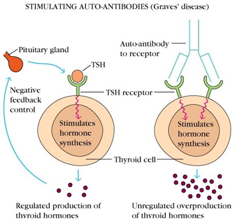 Hyperthyroidism Hyperthyroidism or thyrotoxicosis is a hypermetabolic state that results from an excess of free thyroid hormone (T3 and T4) in blood Graves disease (autoimmune disease) Antibodies to