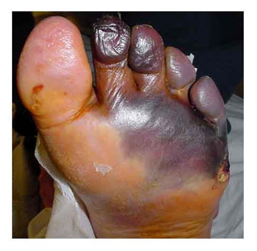 DM Foot gangrene Diabetic nephropathy