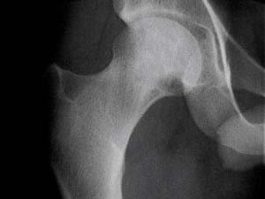 Hip Anatomy The hip is a true ball and socket joint formed by two bony structures The Femoral Head (Ball) The