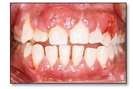 Introduction Bacterial plaque has been established as the primary etiological factor for the initiation of periodontal diseases.