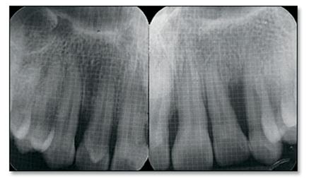 Figure 3. Periapical radiographs showing vertical and horizontal bone loss. Laboratory investigations did not reveal any abnormalities.