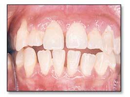 The patient revealed she no longer experienced discomfort when brushing and gingival bleeding had completely stopped.