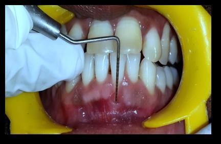 A variety of mucogingival surgeries have been suggested for root coverage.