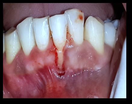gingiva intact (1mm sulcus and 2mm for biological width), of a width more than 1½ times the area of gingival recession.