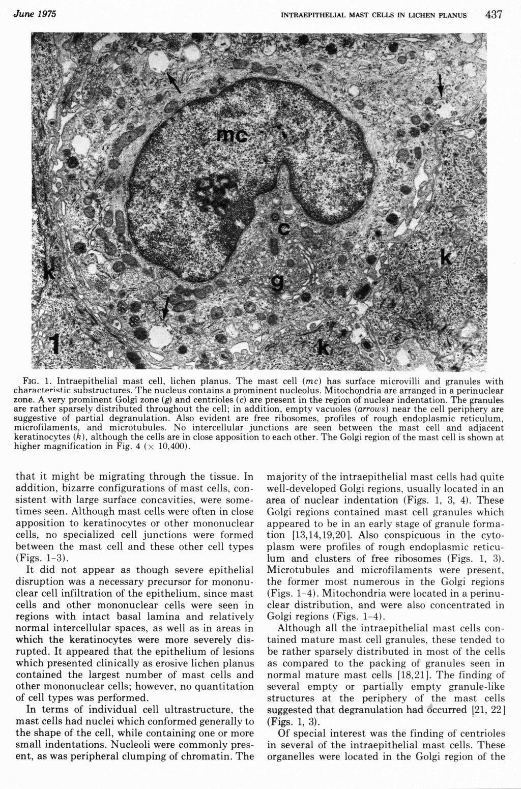 June 1975 INTRAEPITHELIAL MAST CELLS IN LICHEN PLANUS 437 FJG. 1. Intraepithelial mast cell, lichen planus. The mast cell (me) has surface microvilli and granules with substructures.