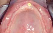 Sufficient peri-implant keratinized mucosa and deep vestibulum