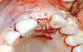 the dermal matrix (6/0 monofil sutures),