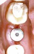 10 It has been demonstrated that a thickness of 2 mm or less increases the risk of crestal bone lack.